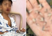 boy 12 teeth extracted (2)