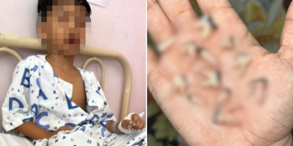 Boy in M'sia has 12 teeth extracted due to cavities, often went to sleep without brushing