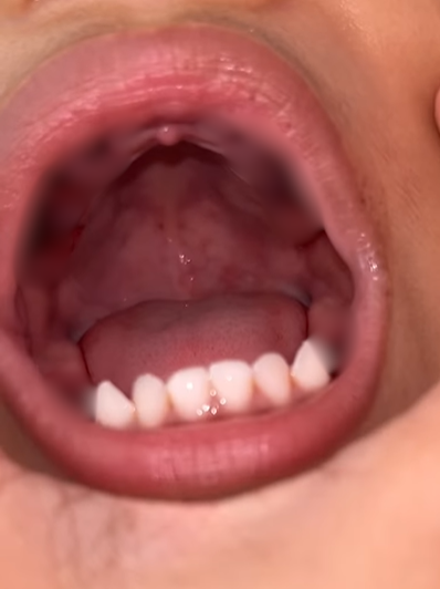 boy 12 teeth extracted