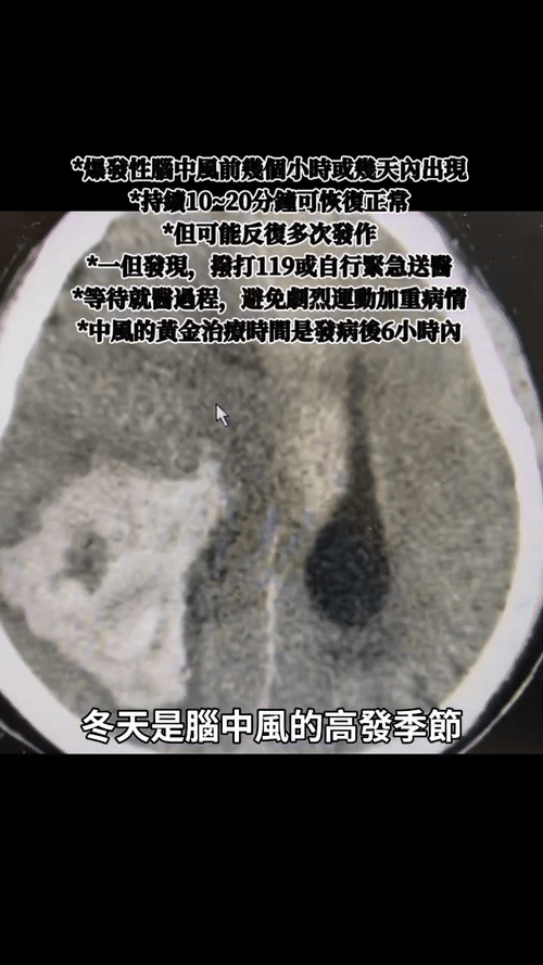 ginger duck cerebral haemorrhage