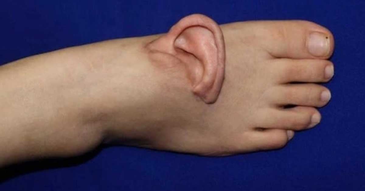 torn-off ear foot transplant
