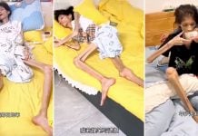 woman gastric atrophy