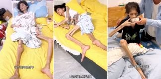 woman gastric atrophy