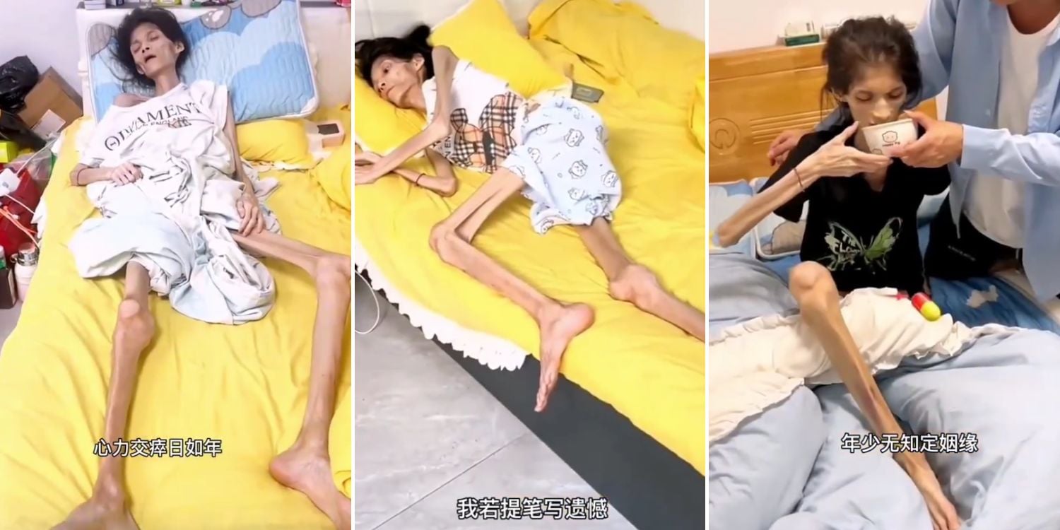 woman gastric atrophy