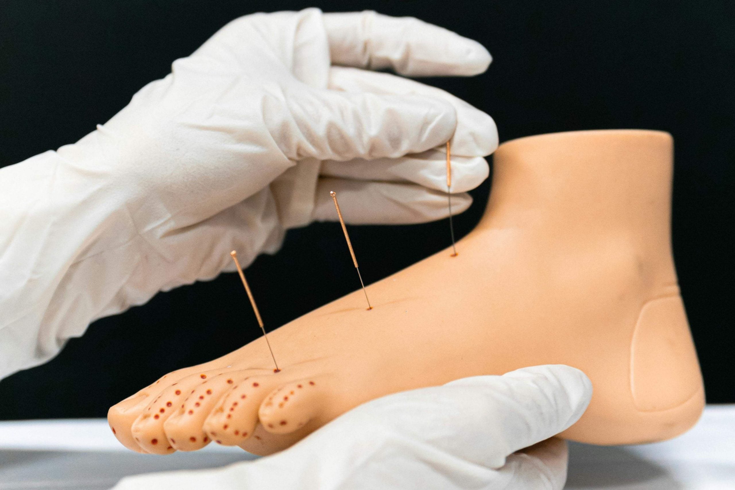 acupuncture needle buttock