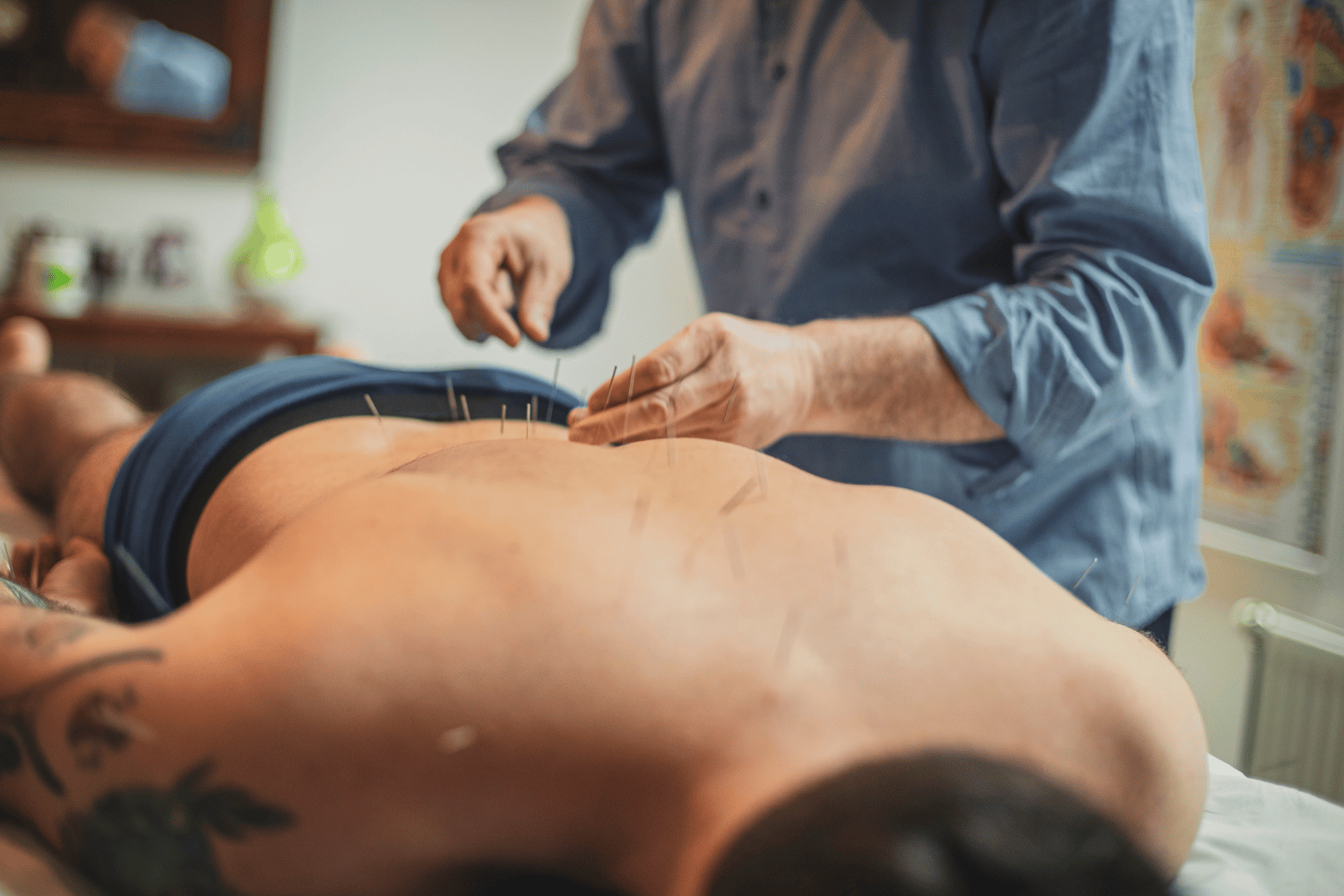 acupuncture needle buttock