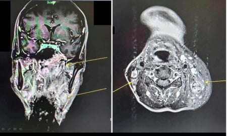man tinnitus nasopharyngeal carcinoma