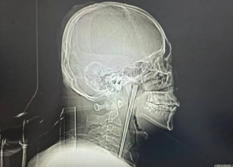 man metal chopstick throat