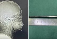 man metal chopstick throat