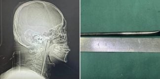 man metal chopstick throat