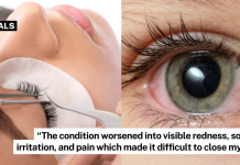 chemical burn lash extension