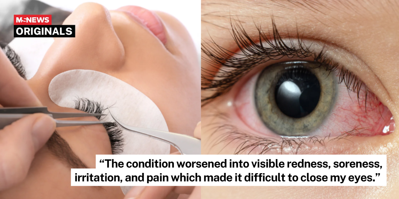 chemical burn lash extension
