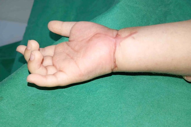 toddler severed hand
