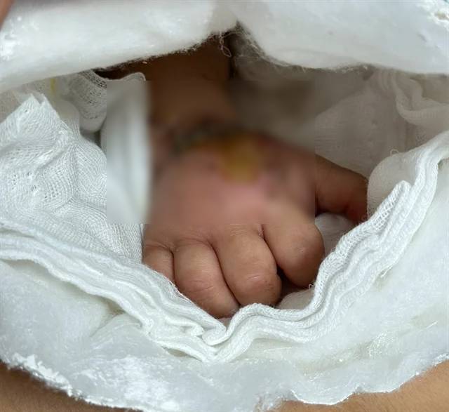 toddler severed hand
