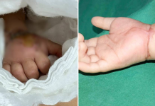 toddler severed hand