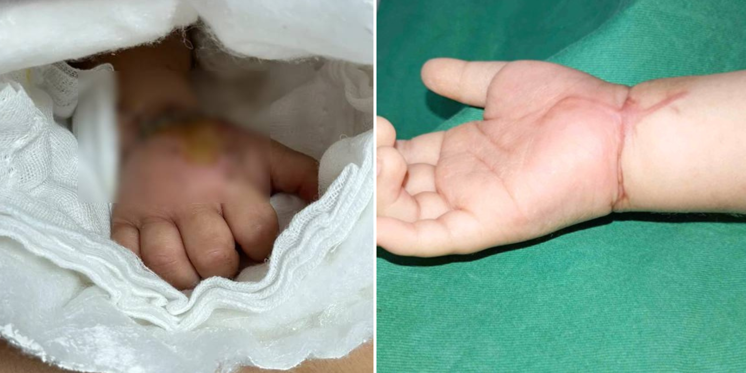 toddler severed hand