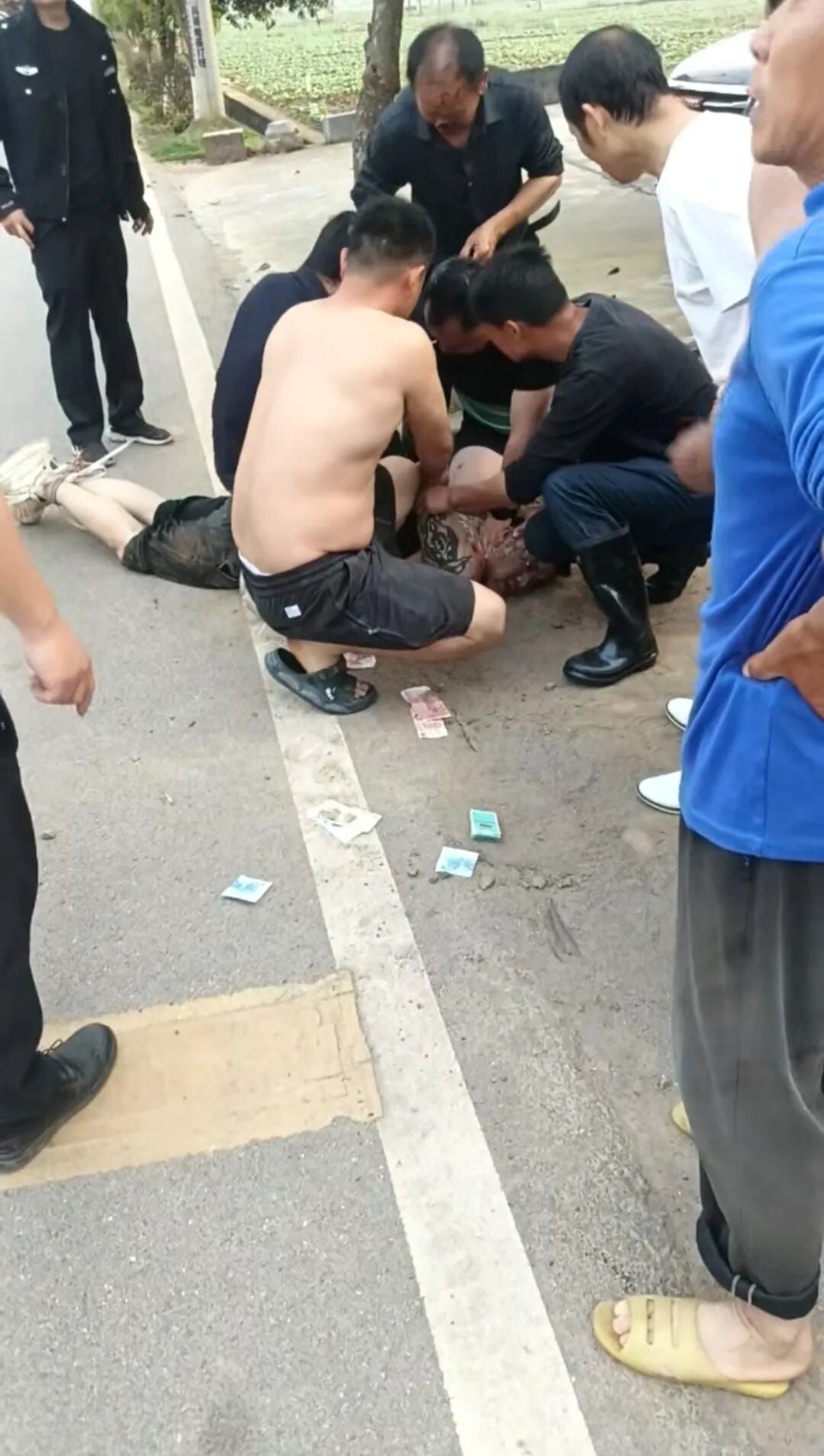 man loses nose
