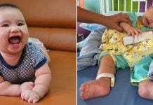 SMA treatment