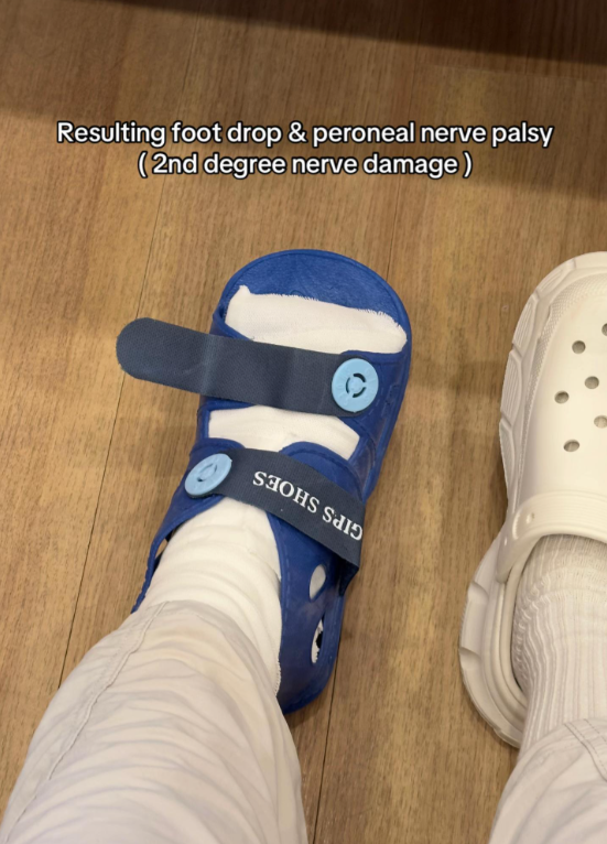 nerve damage acupuncture (3)
