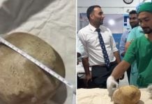 3.1kg bladder stone