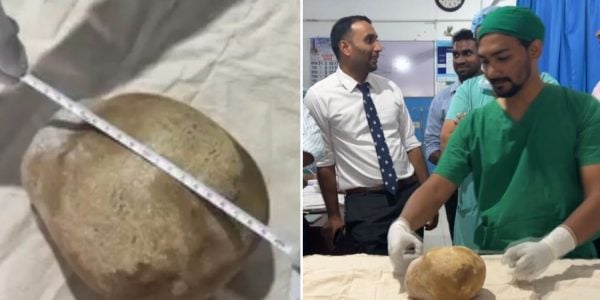 3.1kg bladder stone