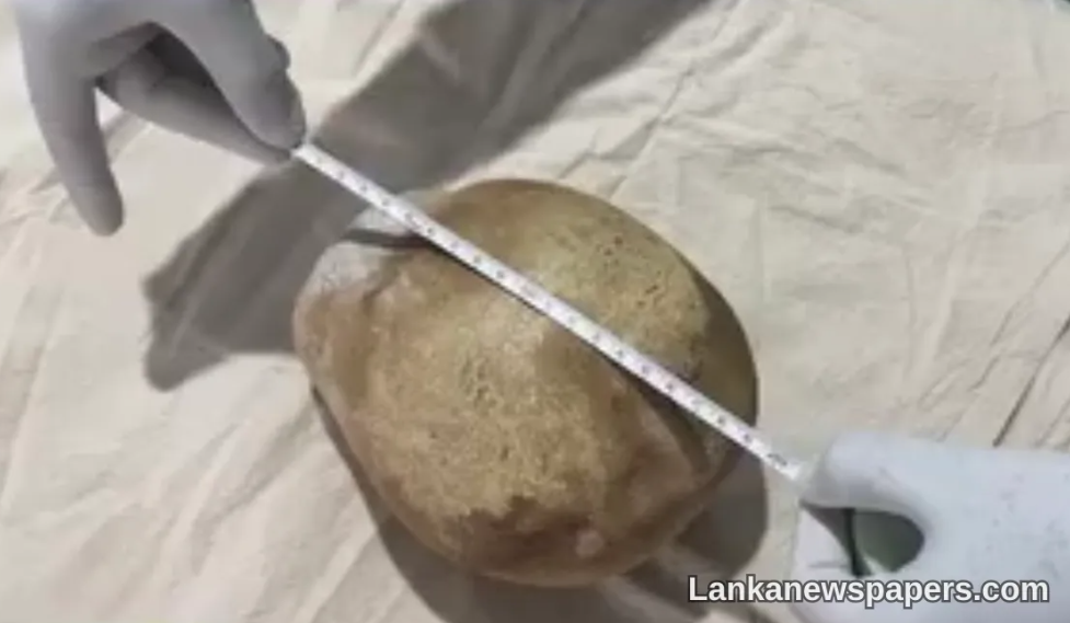 3.1kg bladder stone
