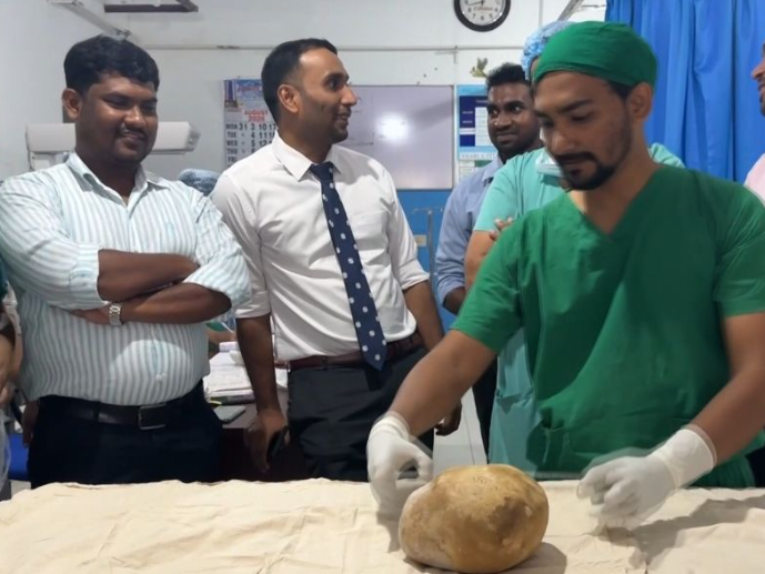 3.1kg bladder stone
