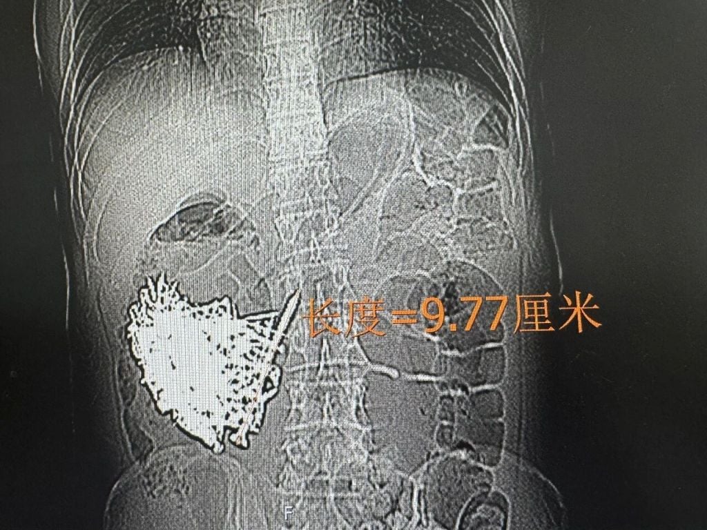 iron nails stomach (2)