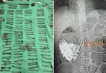 iron nails stomach
