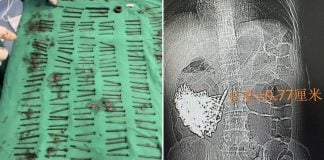 iron nails stomach