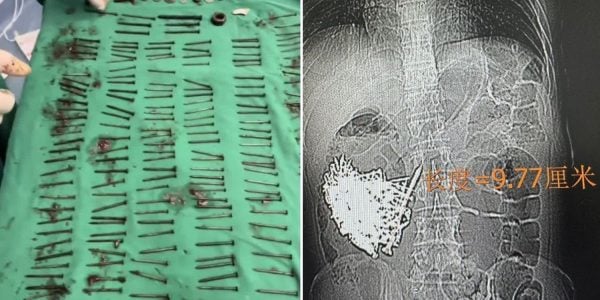 iron nails stomach
