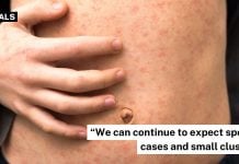 measles cases singapore 2026 (1)