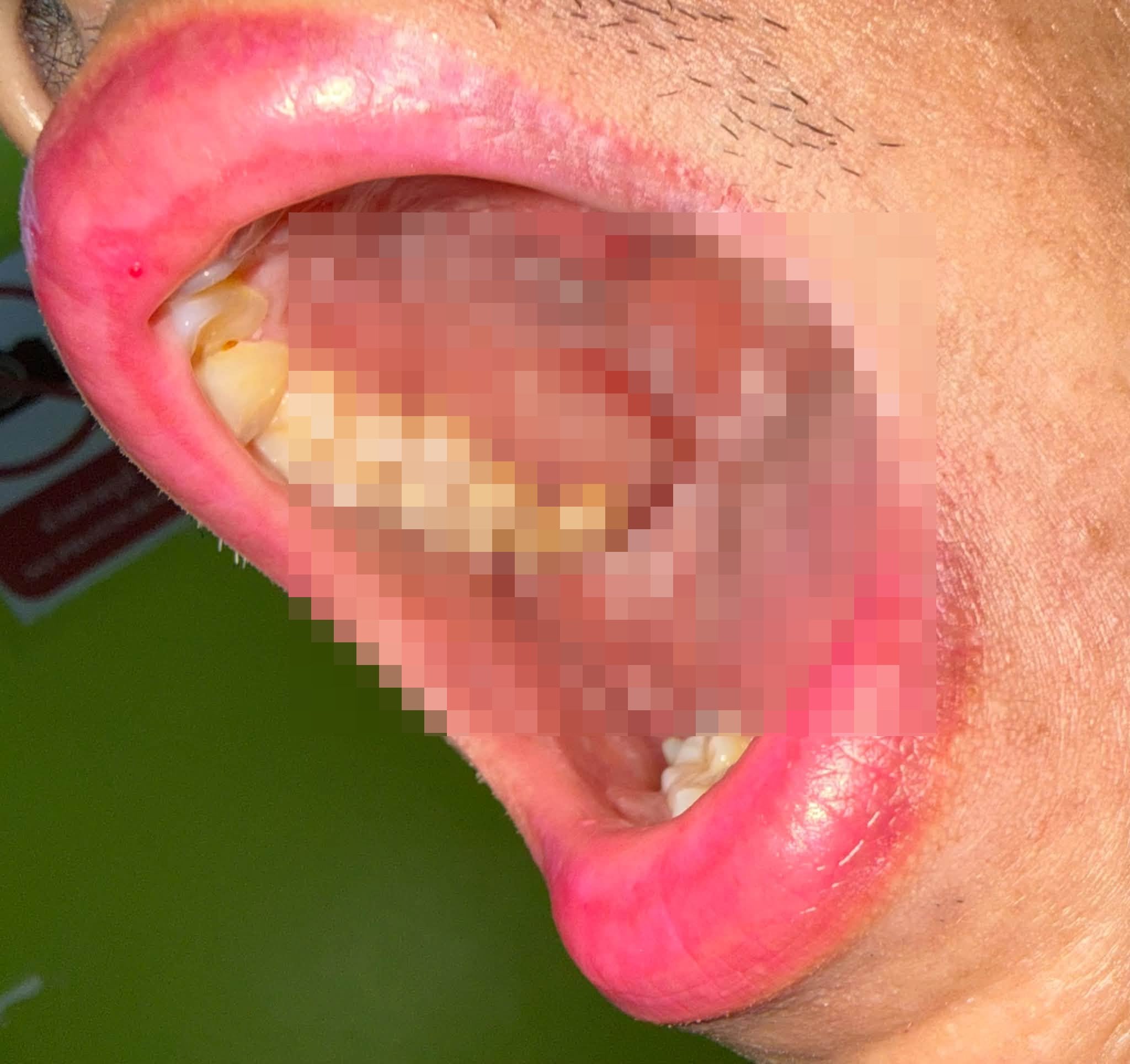 thailand man hiv
