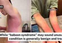Baboon syndrome SDRIFE