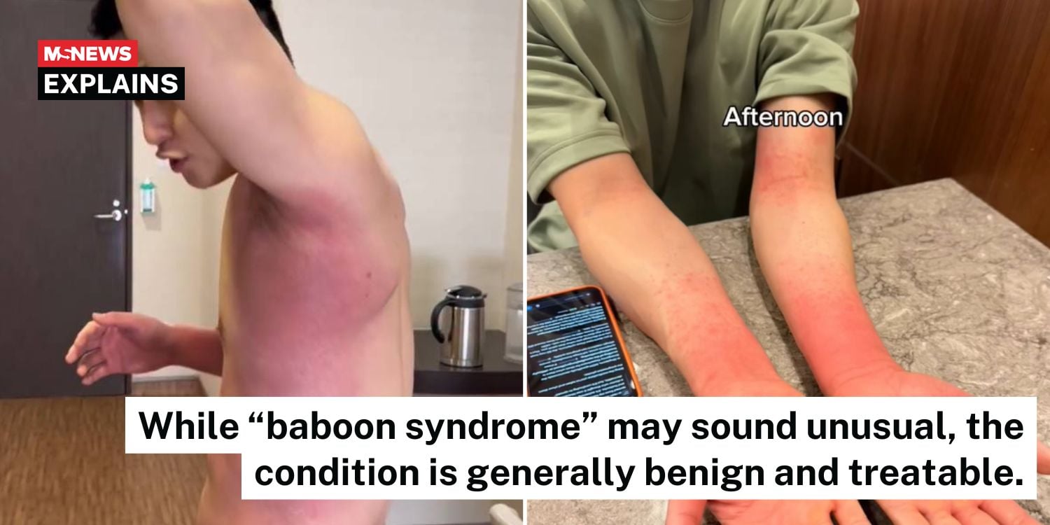Baboon syndrome SDRIFE