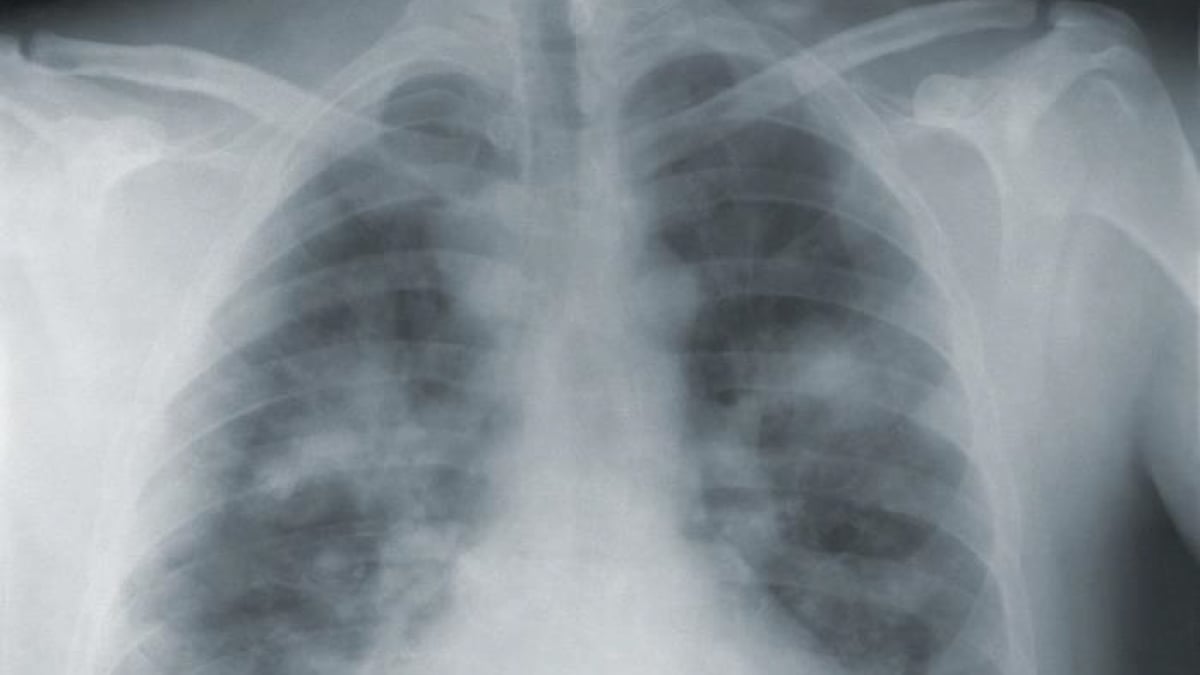 pneumonic plague